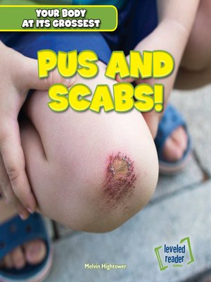 cover image of Pus and Scabs!
